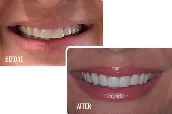 Halo Non-Invasive Dental Veneers Before & After