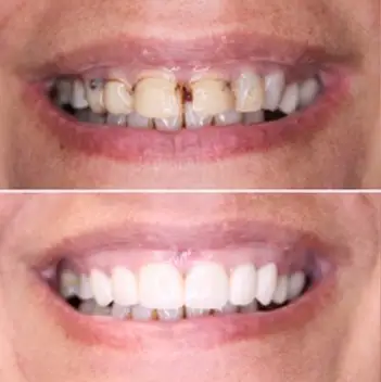 Before and After