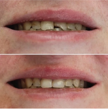 Before and After