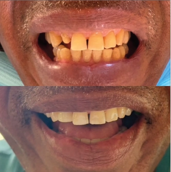 Before and After