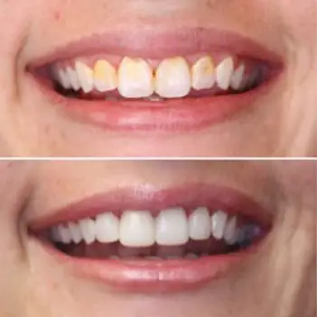 Before and After