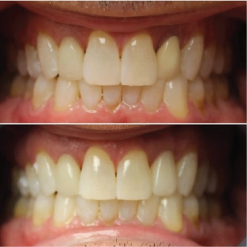 Before and After