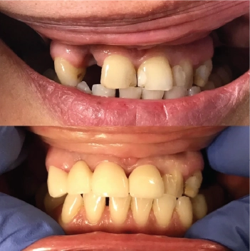 Before and After
