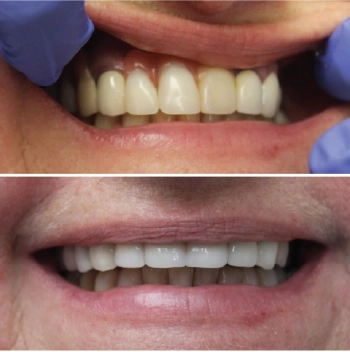 Before and After