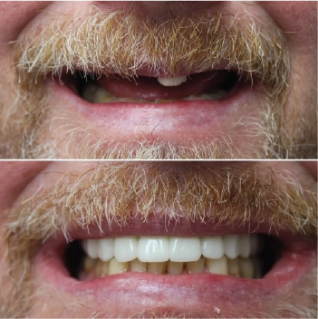 Before and After