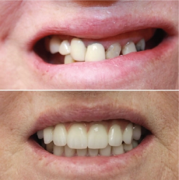 Before and After