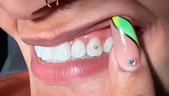 Cosmetic Tooth Gems