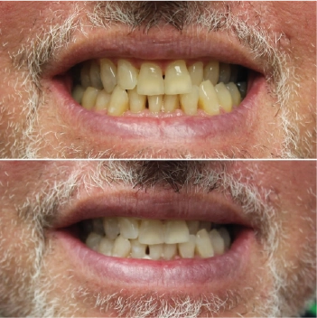 Before and After