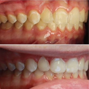 Before and After