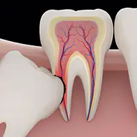 When Should Your Wisdom Teeth be Removed?