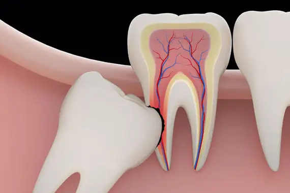 Wisdom teeth are the last teeth to erupt and can require removal for a variety of reasons