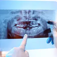 Benefits of Bitewing Digital X-Rays