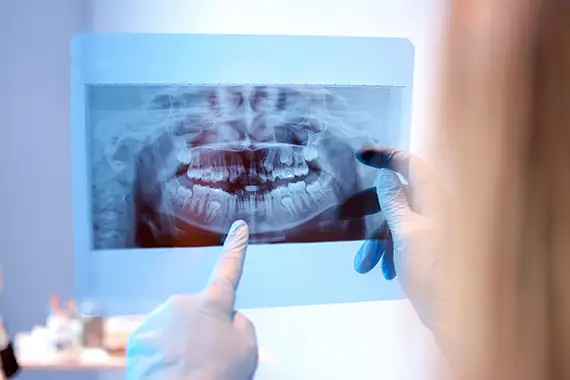 Benefits of Bitewing Digital X-Rays