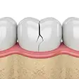 Cracked tooth illustration