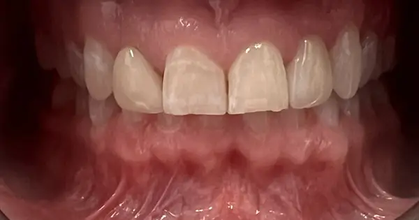Before and After