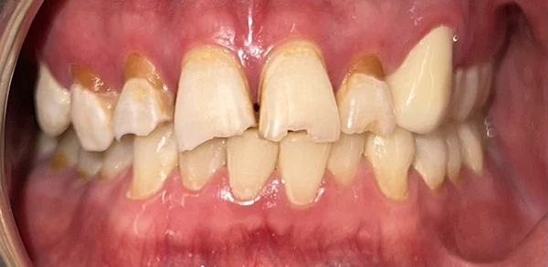 Patient's appearance before treatment, showcasing initial condition.