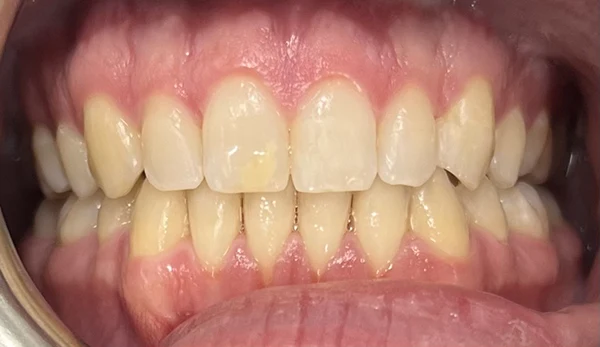 Post-treatment improvement showcasing enhanced facial appearance.