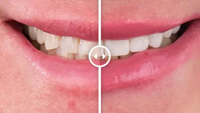 Before and After