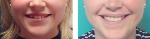 Before and After