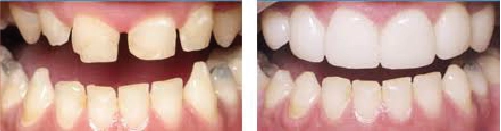Before and After