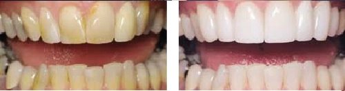 Before and After
