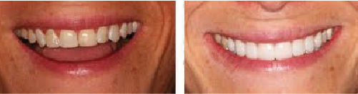 Before and After