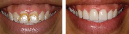 Before and After