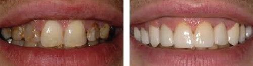 Before and After