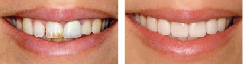 Before and After