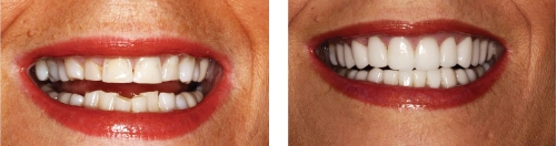 Before and After
