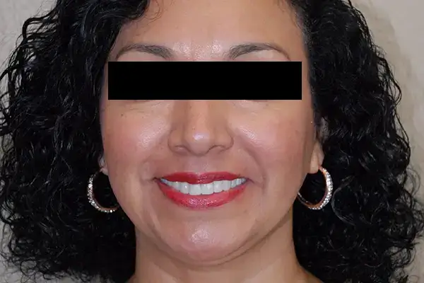 Before and After