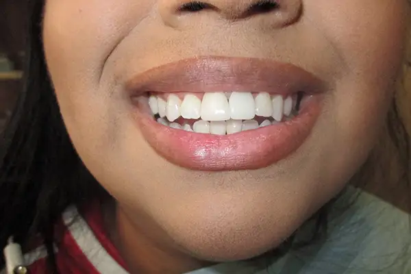 Before and After