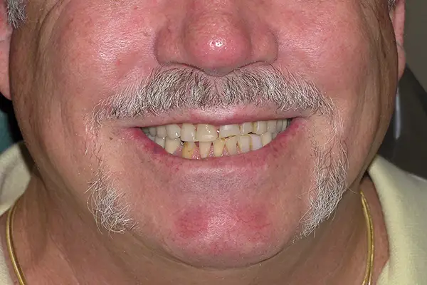Before and After