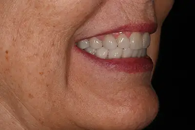 Before and After