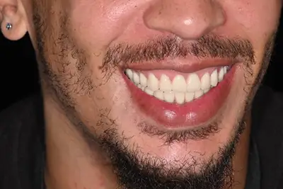 Before and After