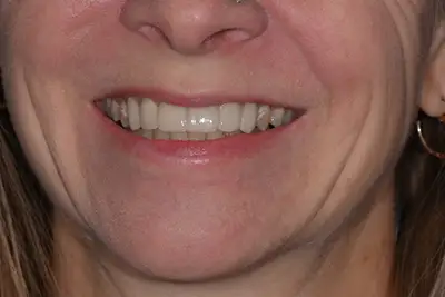 Before and After