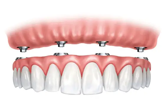 Medical illustration of a full-arch dental prosthesis snapping onto implants in the jaw.