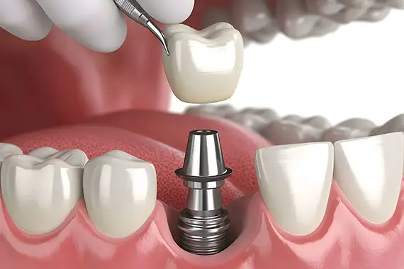 Illustration of a dental crown being placed onto an implant post