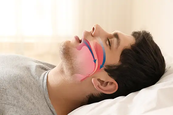 NightLase® Therapy (Laser Snoring & Sleep Apnea Treatment)