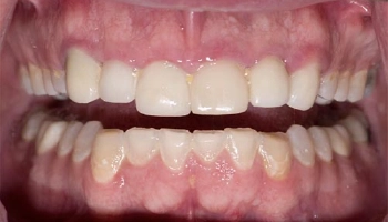 Before and after images of crown lengthening and zirconia crowns.