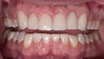 Patient's smile before and after crown lengthening and zirconia crowns.
