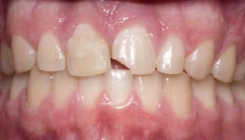 Before and after images of a dental implant and crown restoration.