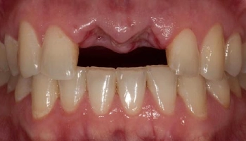 Before and after images of incisor implants with crowns.