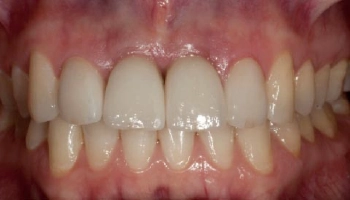Before and after comparison of incisor implants and crowns.