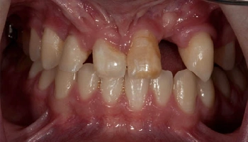 Before and after images of dental implants with a bridge.