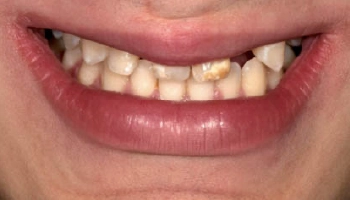 Before and after images of dental implants supporting a bridge.