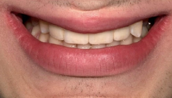 Before and after images of cleft palate dental implants.