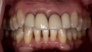 Before and after comparison of zirconia crowns on teeth.