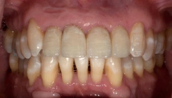 Transformative result showing polished porcelain layered zirconia crowns.