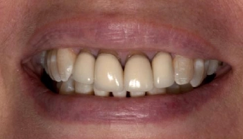 Dramatic smile transformation with porcelain layered zirconia crowns.